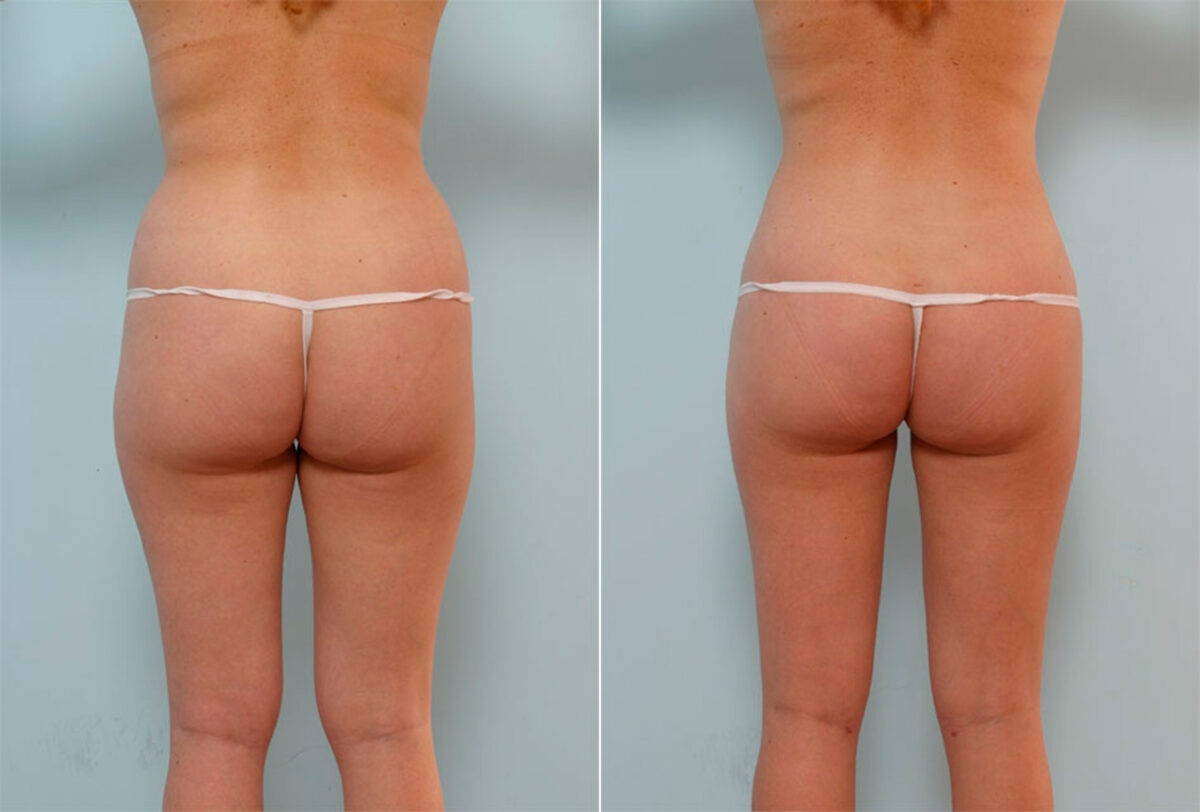 Liposuction before and after photos in Houston, TX, Patient 29031