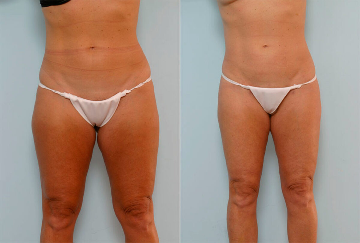 Liposuction before and after photos in Houston, TX, Patient 29038