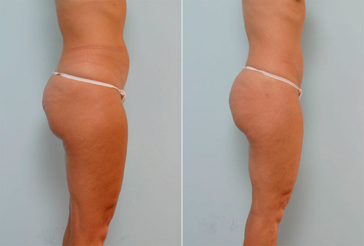 Liposuction before and after photos in Houston, TX, Patient 29038