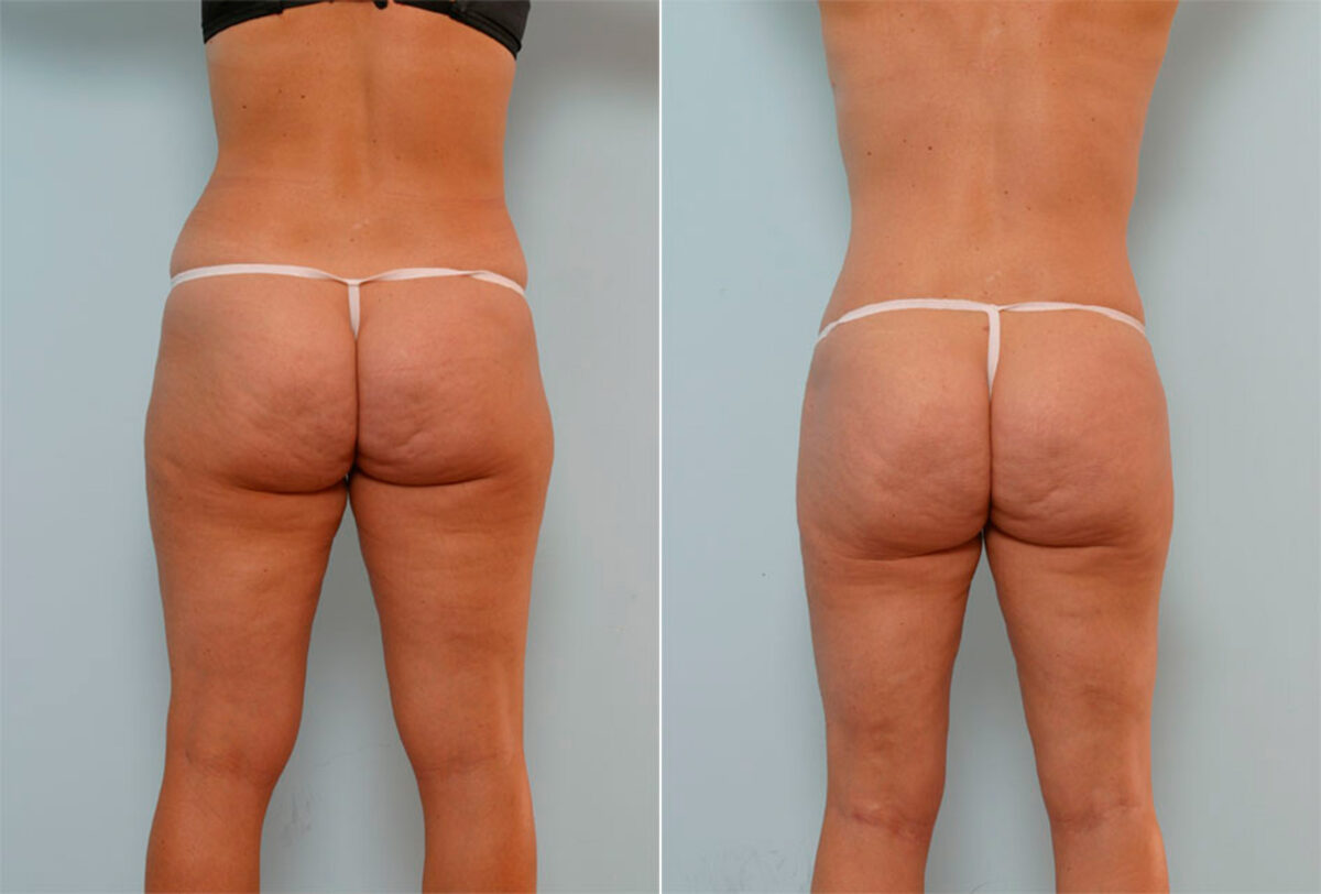 Liposuction before and after photos in Houston, TX, Patient 29038