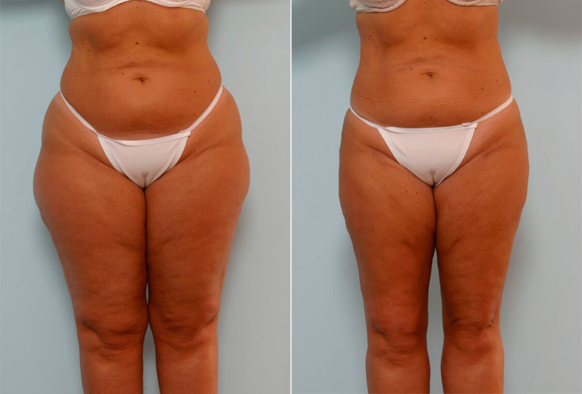 Liposuction before and after photos in Houston, TX, Patient 29045