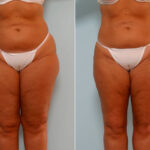 Liposuction before and after photos in Houston, TX, Patient 29045