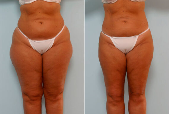 Liposuction before and after photos in Houston, TX, Patient 29045