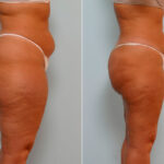 Liposuction before and after photos in Houston, TX, Patient 29045