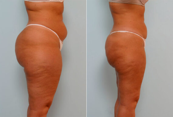 Liposuction before and after photos in Houston, TX, Patient 29045