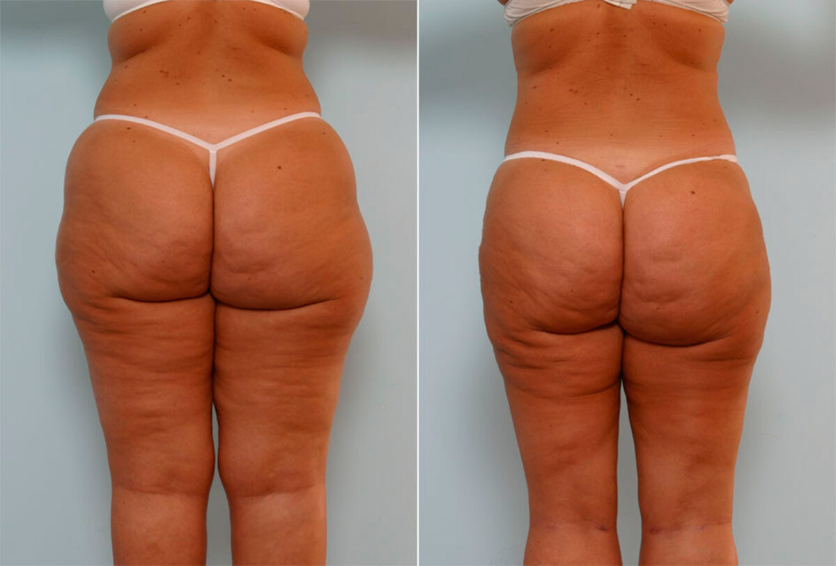 Liposuction before and after photos in Houston, TX, Patient 29045