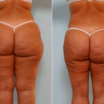 Liposuction before and after photos in Houston, TX, Patient 29045