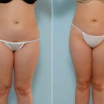 Liposuction before and after photos in Houston, TX, Patient 29052