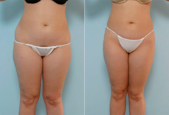 Liposuction before and after photos in Houston, TX, Patient 29052