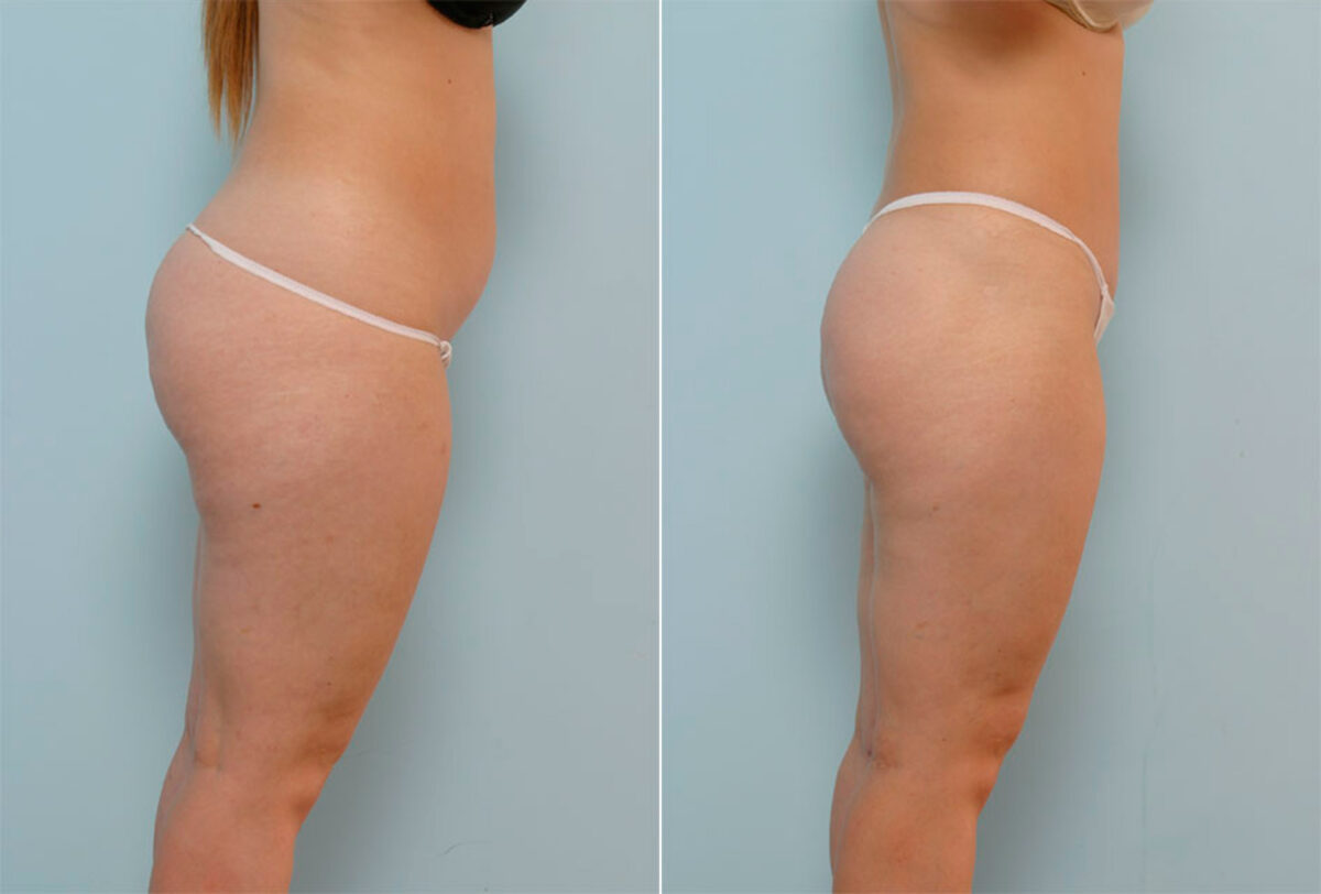 Liposuction before and after photos in Houston, TX, Patient 29052