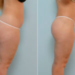 Liposuction before and after photos in Houston, TX, Patient 29052