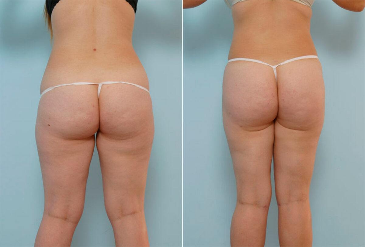 Liposuction before and after photos in Houston, TX, Patient 29052