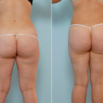 Liposuction before and after photos in Houston, TX, Patient 29052