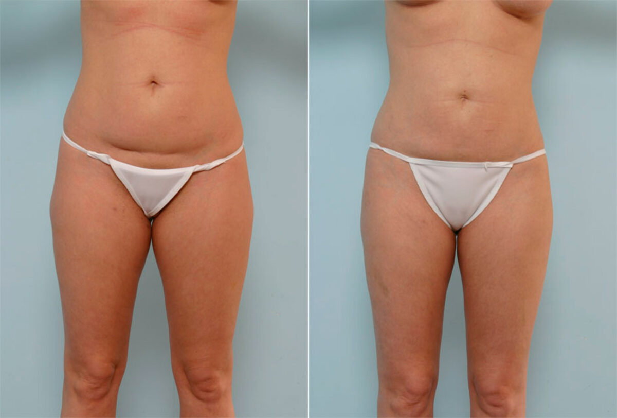 Liposuction before and after photos in Houston, TX, Patient 29059