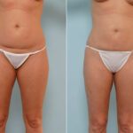 Liposuction before and after photos in Houston, TX, Patient 29059