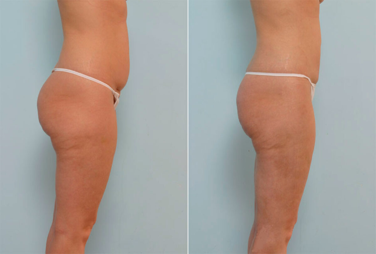 Liposuction before and after photos in Houston, TX, Patient 29059