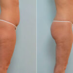 Liposuction before and after photos in Houston, TX, Patient 29059