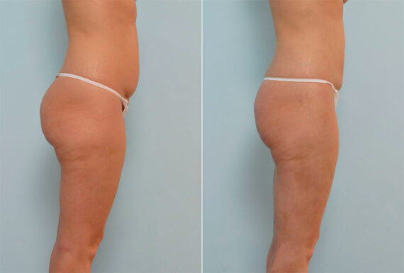 Liposuction before and after photos in Houston, TX, Patient 29059