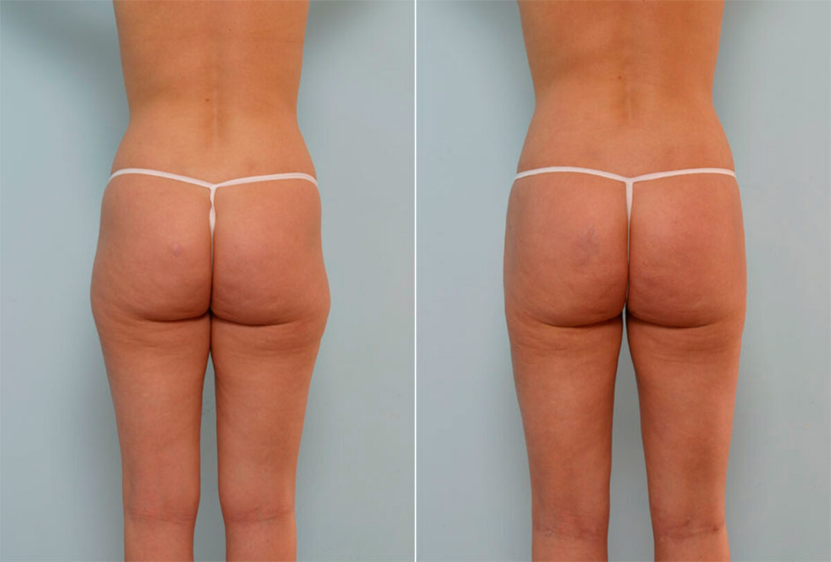 Liposuction before and after photos in Houston, TX, Patient 29059