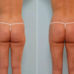 Liposuction before and after photos in Houston, TX, Patient 29059