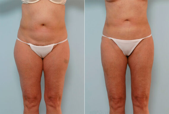 Liposuction before and after photos in Houston, TX, Patient 29066