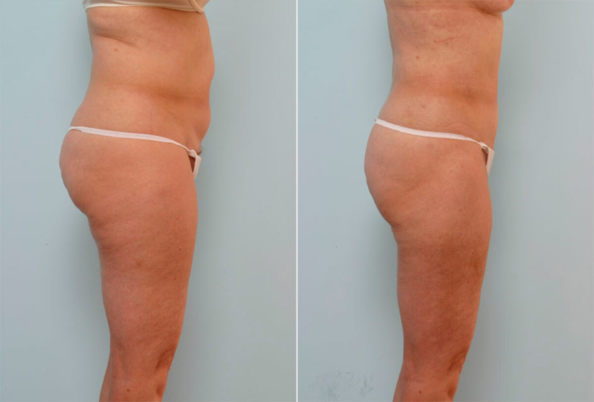 Liposuction before and after photos in Houston, TX, Patient 29066