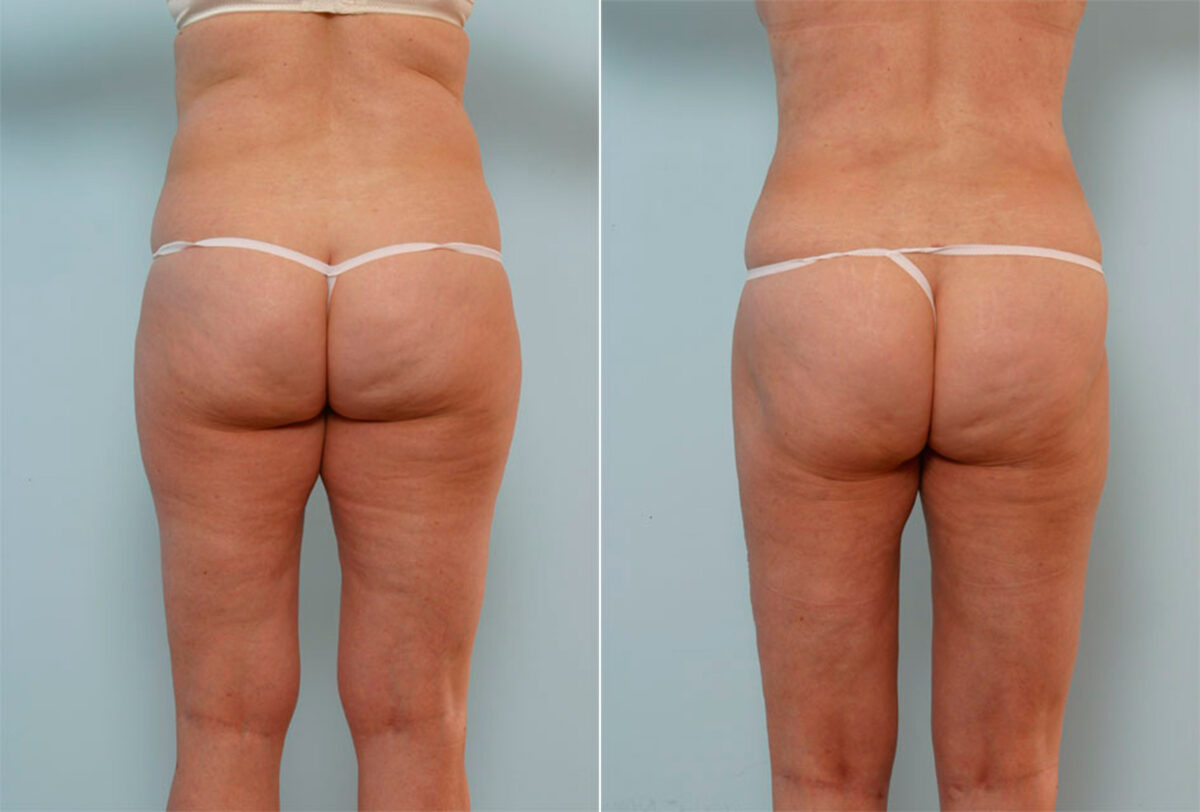 Liposuction before and after photos in Houston, TX, Patient 29066