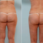 Liposuction before and after photos in Houston, TX, Patient 29066