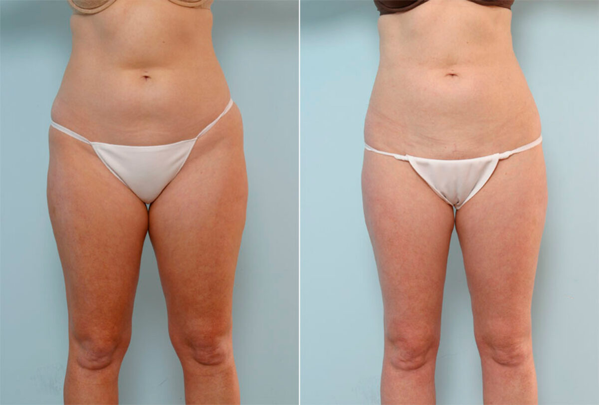 Liposuction before and after photos in Houston, TX, Patient 29073