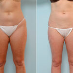 Liposuction before and after photos in Houston, TX, Patient 29073