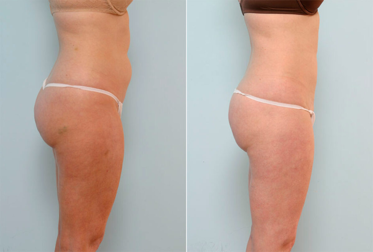 Liposuction before and after photos in Houston, TX, Patient 29073