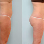 Liposuction before and after photos in Houston, TX, Patient 29073