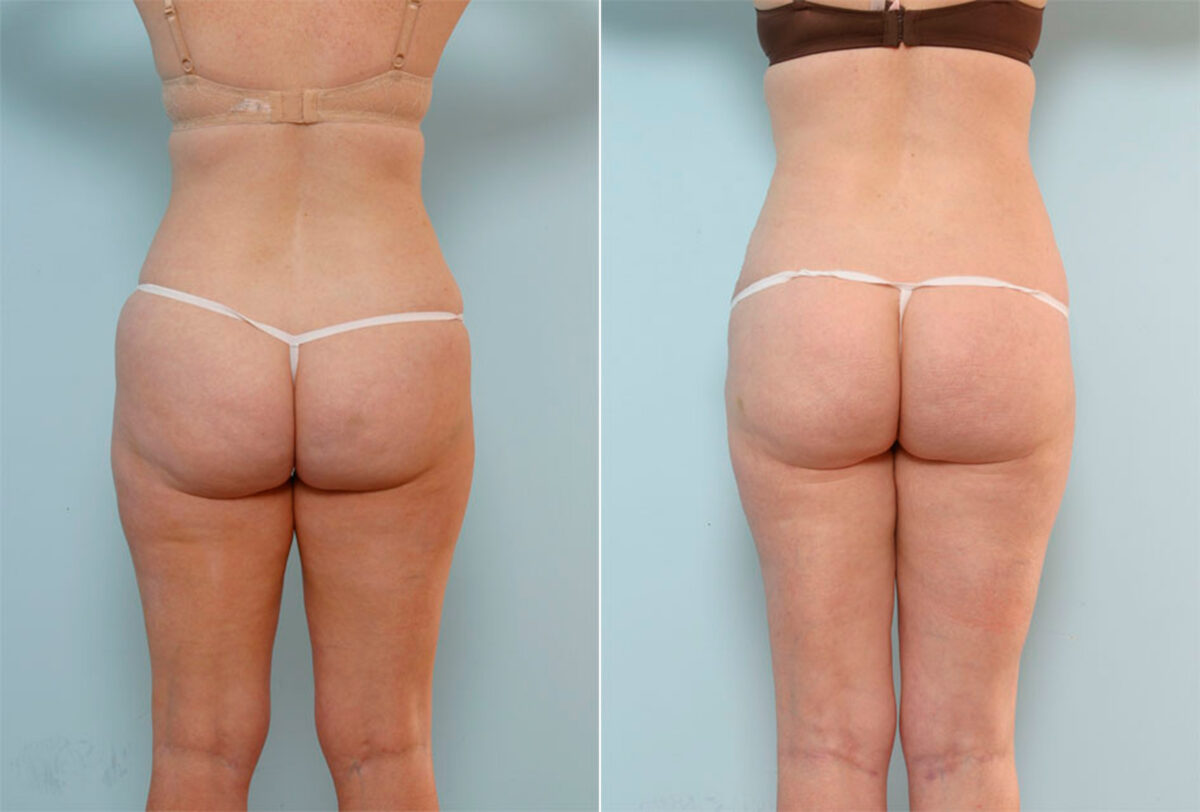 Liposuction before and after photos in Houston, TX, Patient 29073