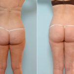 Liposuction before and after photos in Houston, TX, Patient 29073