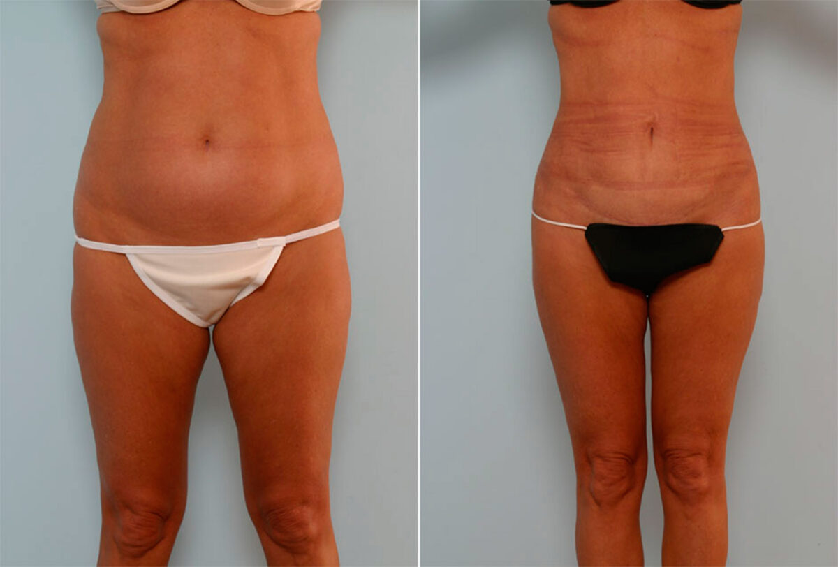 Liposuction before and after photos in Houston, TX, Patient 29080