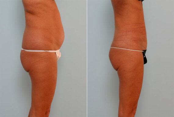 Liposuction before and after photos in Houston, TX, Patient 29080