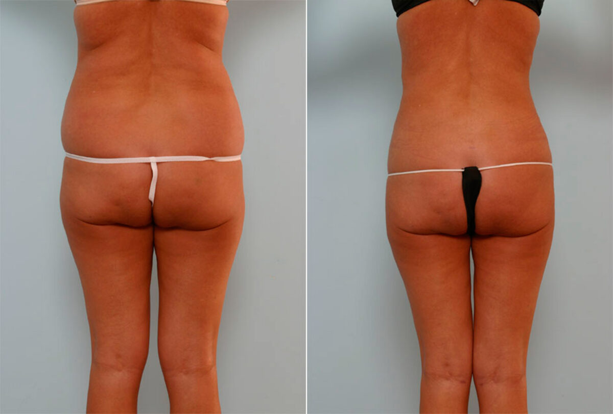 Liposuction before and after photos in Houston, TX, Patient 29080