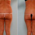 Liposuction before and after photos in Houston, TX, Patient 29080