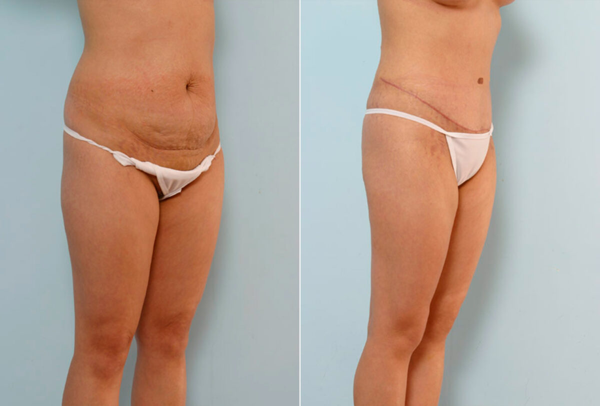 Abdominoplasty before and after photos in Houston, TX, Patient 24243