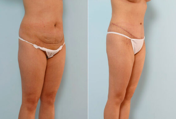 Tummy Tuck/Abdominoplasty before and after photos in Houston, TX, Patient 24243