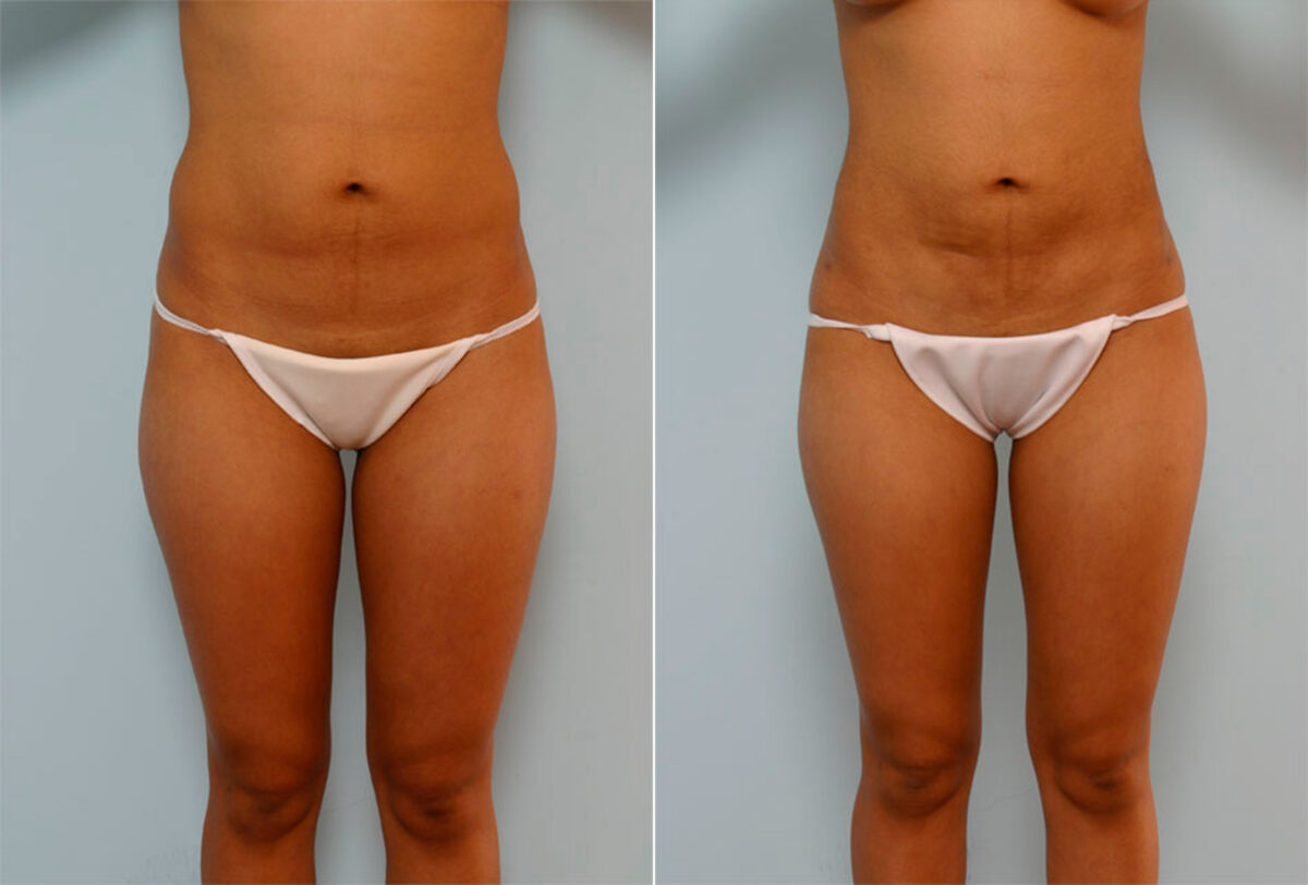 Liposuction before and after photos in Houston, TX, Patient 29094