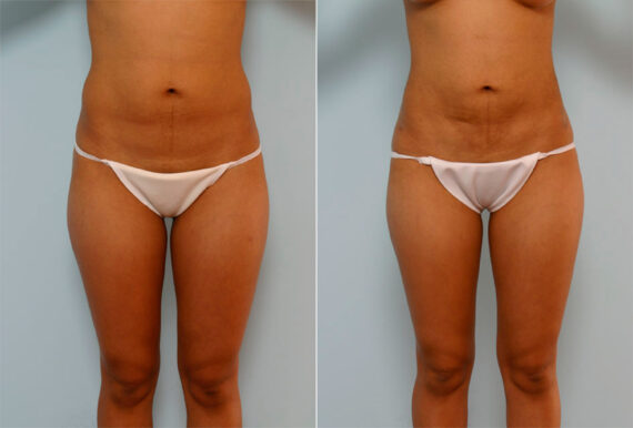 Liposuction before and after photos in Houston, TX, Patient 29094