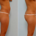 Liposuction before and after photos in Houston, TX, Patient 29094