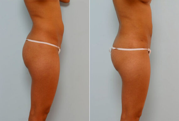 Liposuction before and after photos in Houston, TX, Patient 29094