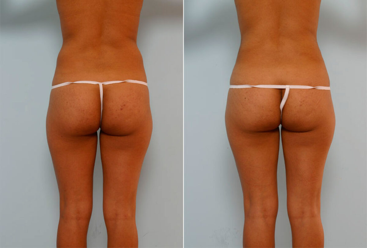 Liposuction before and after photos in Houston, TX, Patient 29094