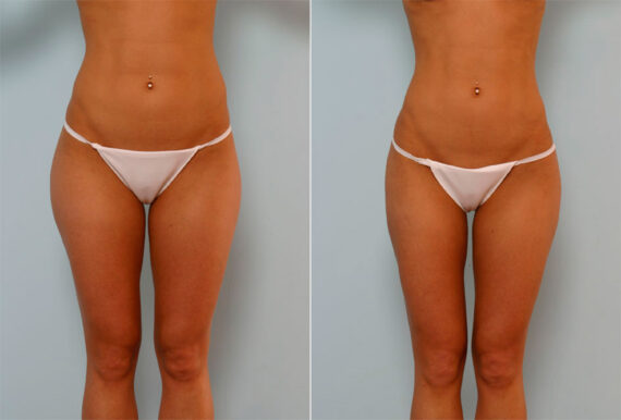 Liposuction before and after photos in Houston, TX, Patient 29101