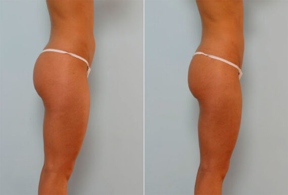 Liposuction before and after photos in Houston, TX, Patient 29101