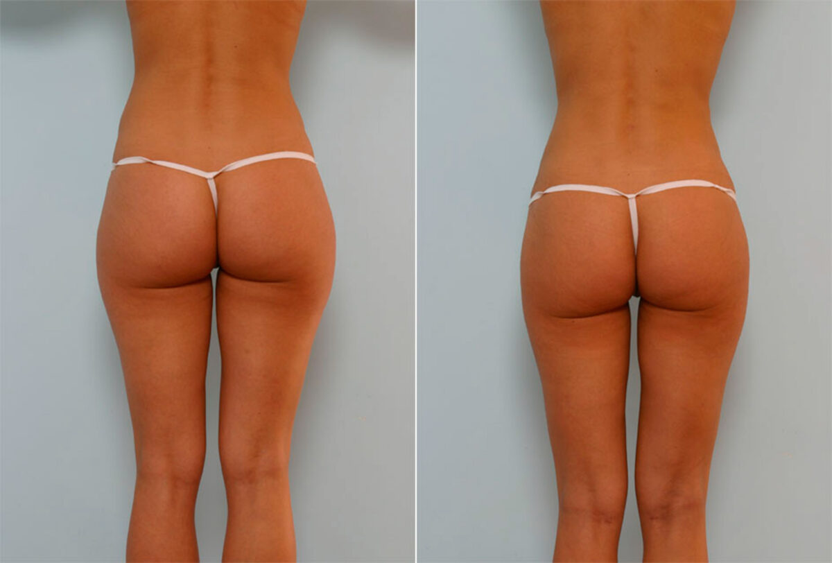 Liposuction before and after photos in Houston, TX, Patient 29101