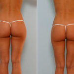 Liposuction before and after photos in Houston, TX, Patient 29101