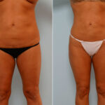 Liposuction before and after photos in Houston, TX, Patient 29108